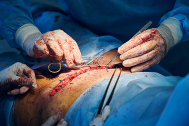 There is a dangerous misconception that surgical procedures such as liposuction are meant for extreme weight loss. This is far from the truth.